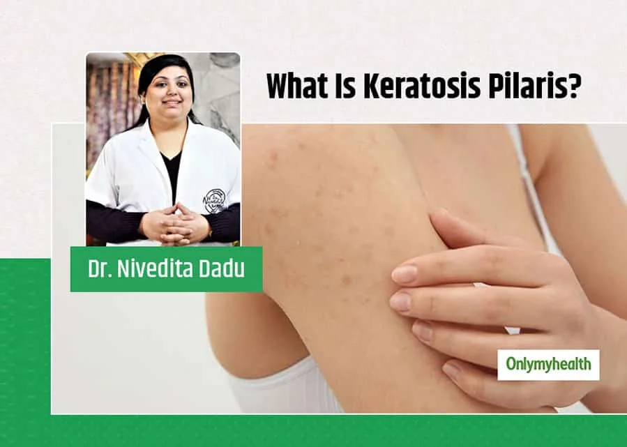 All You Need To Know About Keratosis Pilaris From Renowned Dermatologist