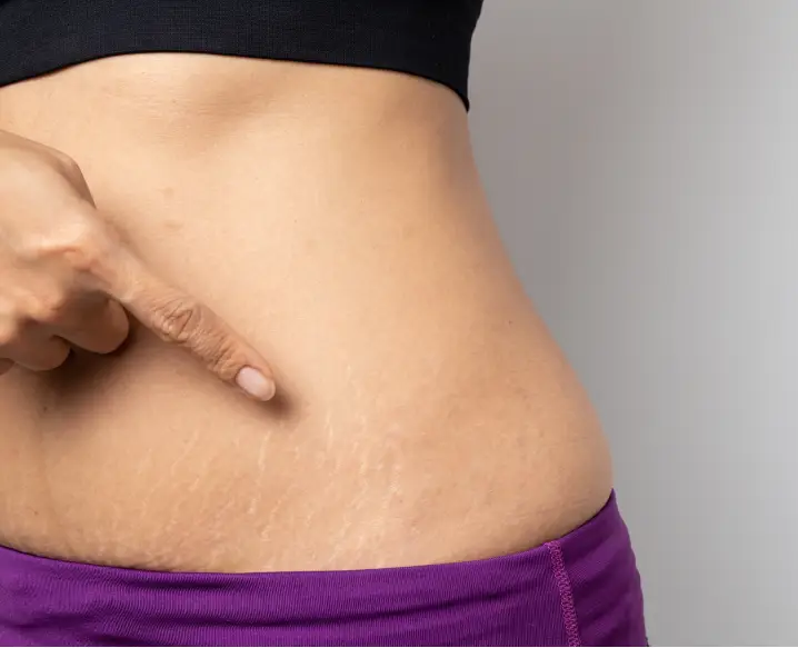 Stretch Marks Treatment with Neoclone Technology in Delhi