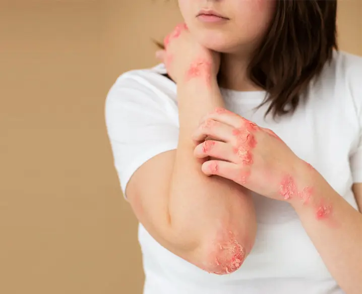 Seborrheic Dermatitis Treatment in Delhi