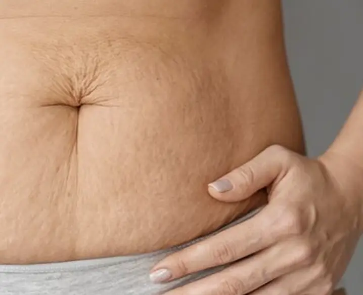 Stretch Marks Treatment In Delhi