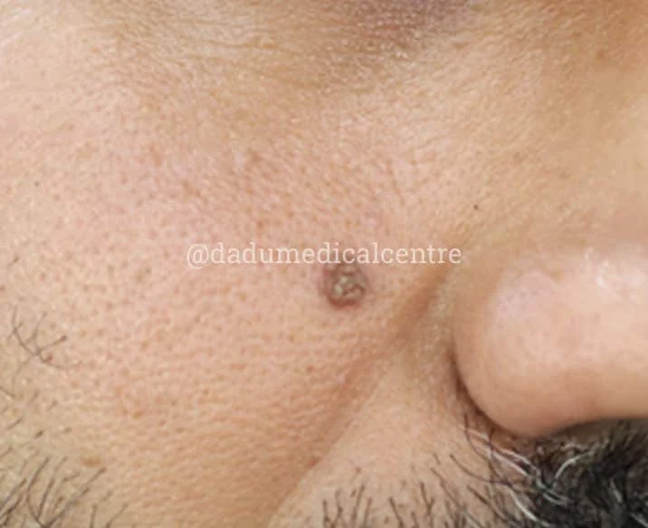 Warts Removal Treatment in Delhi