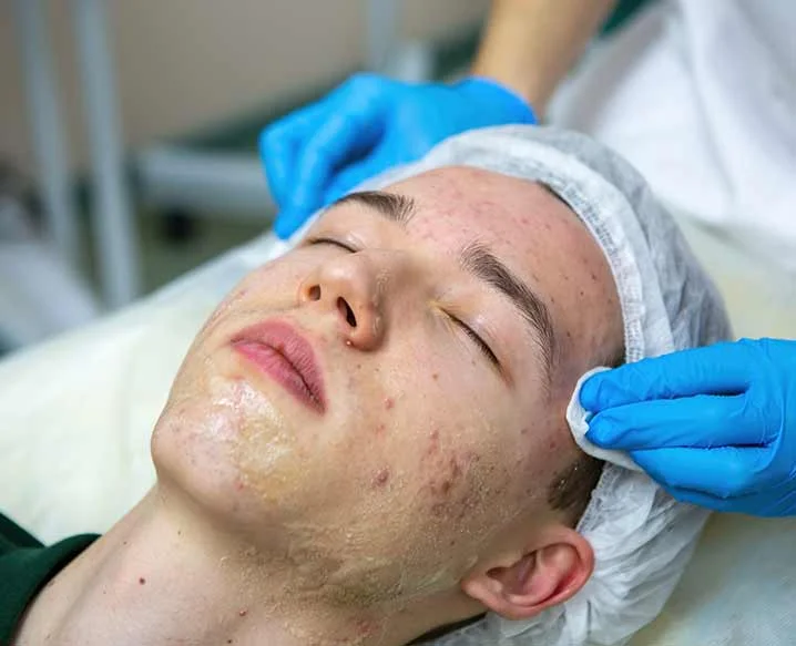 Acne Treatment in Delhi