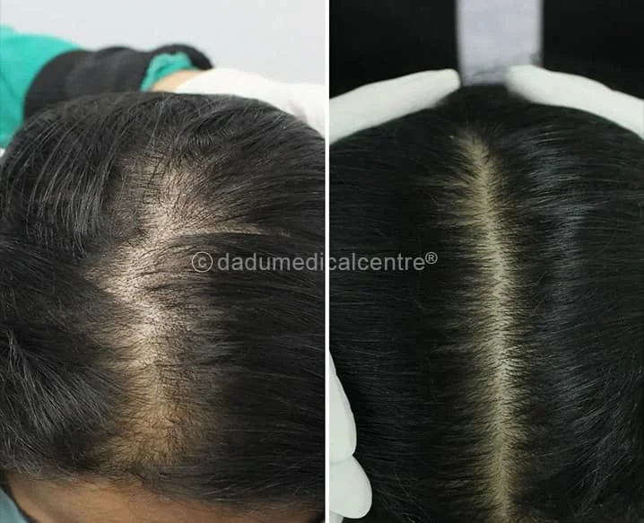 Woman Hair-Fall Treatment