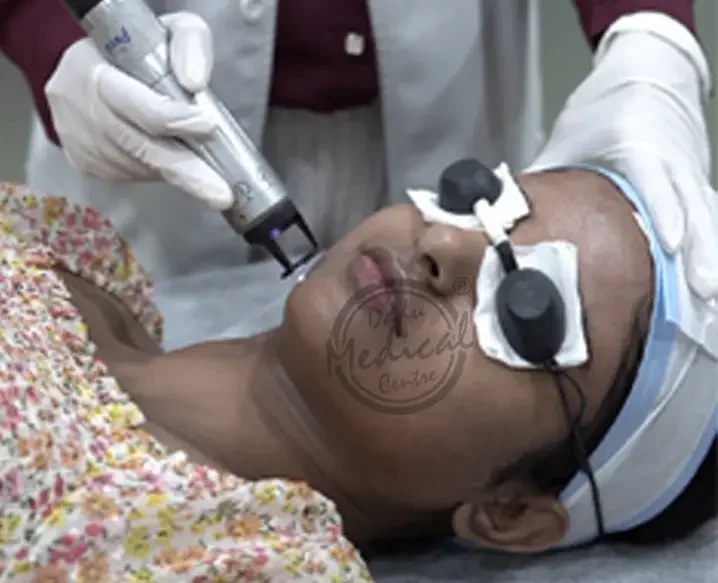 Facial Laser Hair Removal In Delhi
