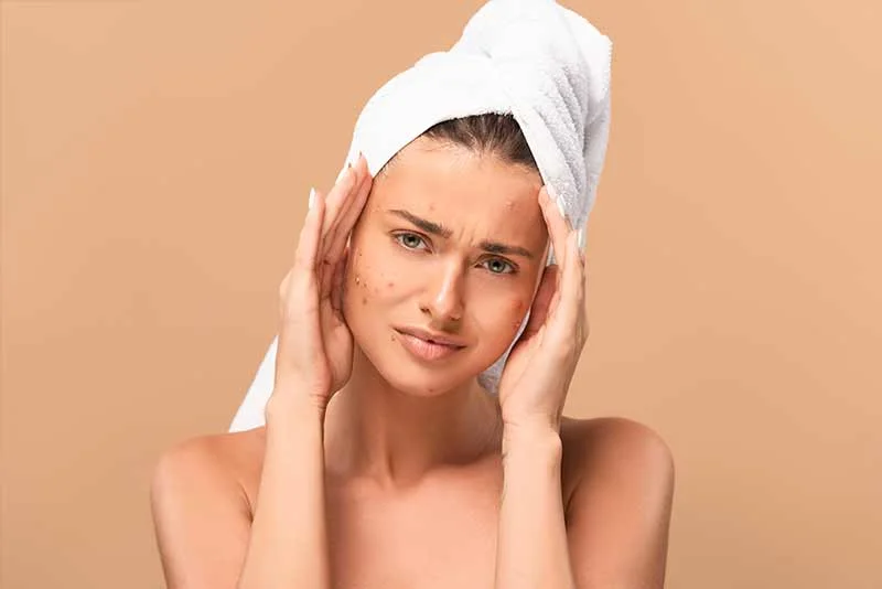 Acne & Pimple Treatment in Delhi