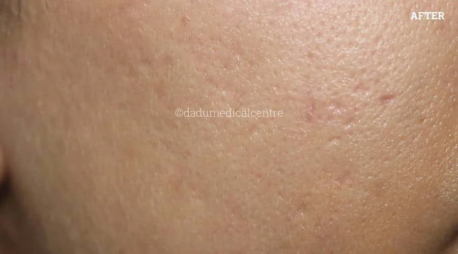 Acne Scar Laser Treatment