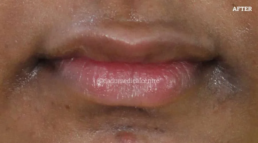 Lip Enhancement