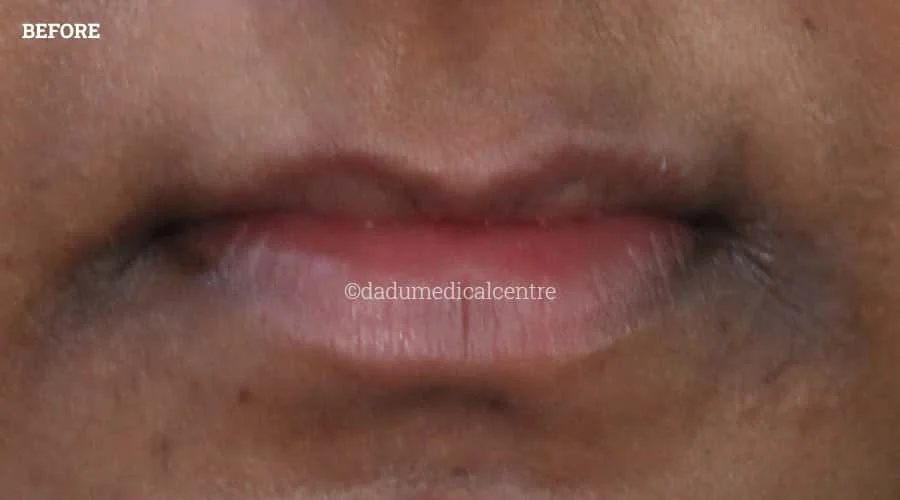 Lip Enhancement