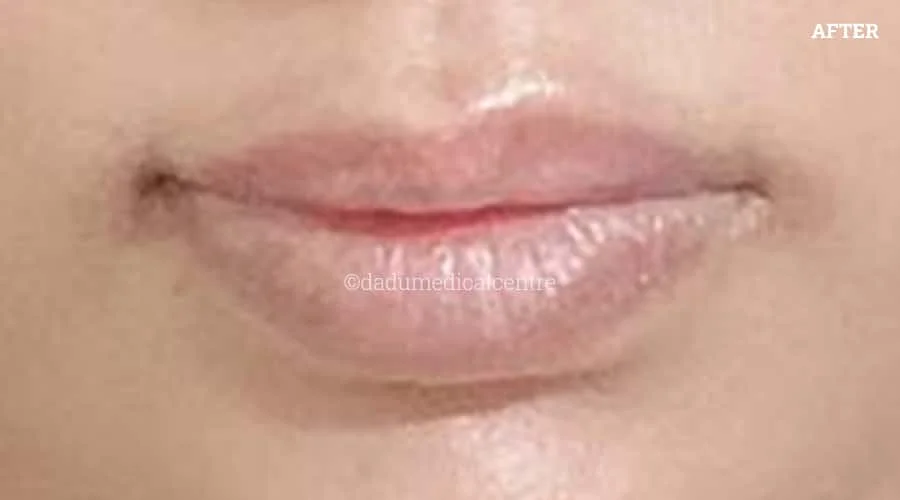 Lip Enhancement