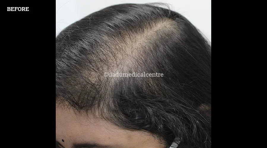 Hair Transplant