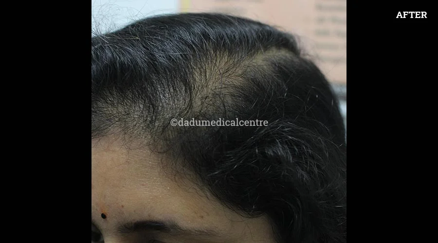 Hair Transplant