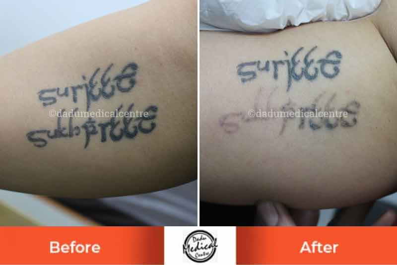 Laser Tattoo Removal Treatment in Hyderabad