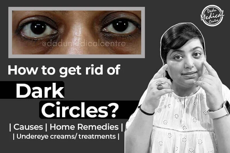 Dark Circles Treatment