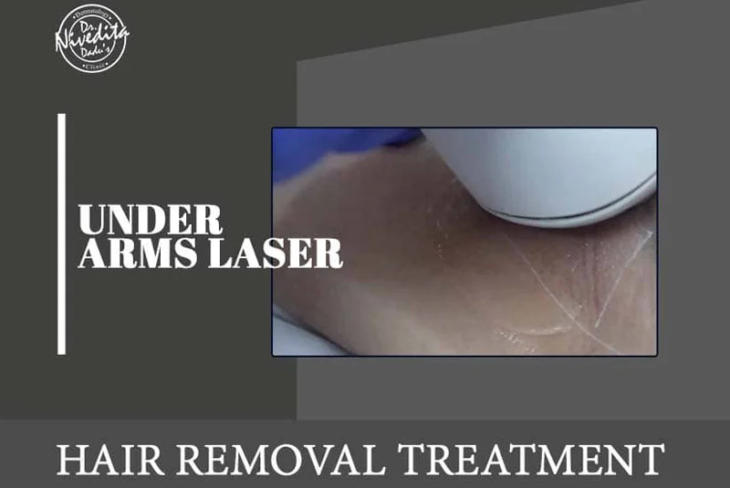 Underarm Laser Hair Removal