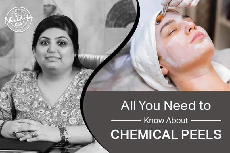 Chemical Peels