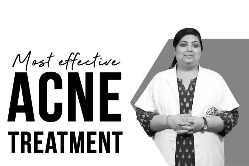 Best Acne Treatments | Do's and Dont's of Acne