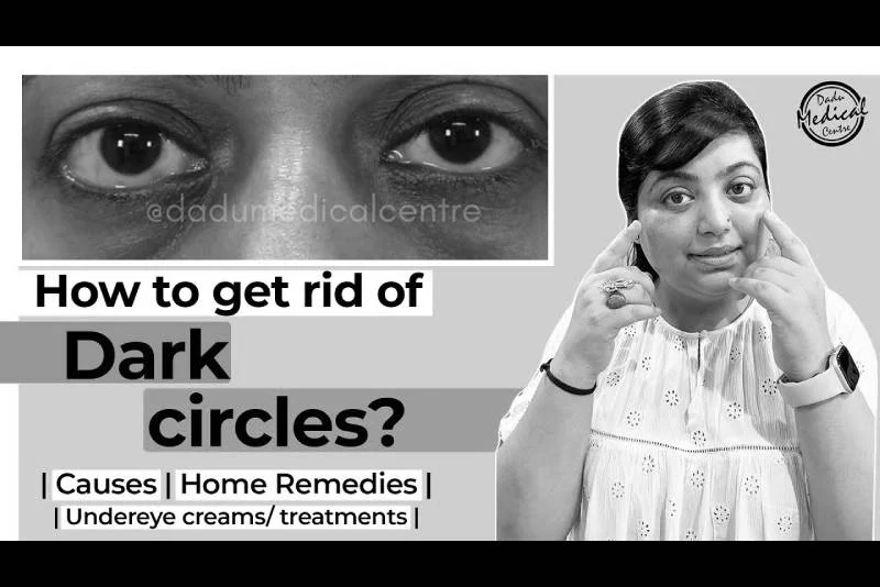 How To Get Rid Of Dark Circles? | Dark Circles Treatment | Dr. Nivedita Dadu