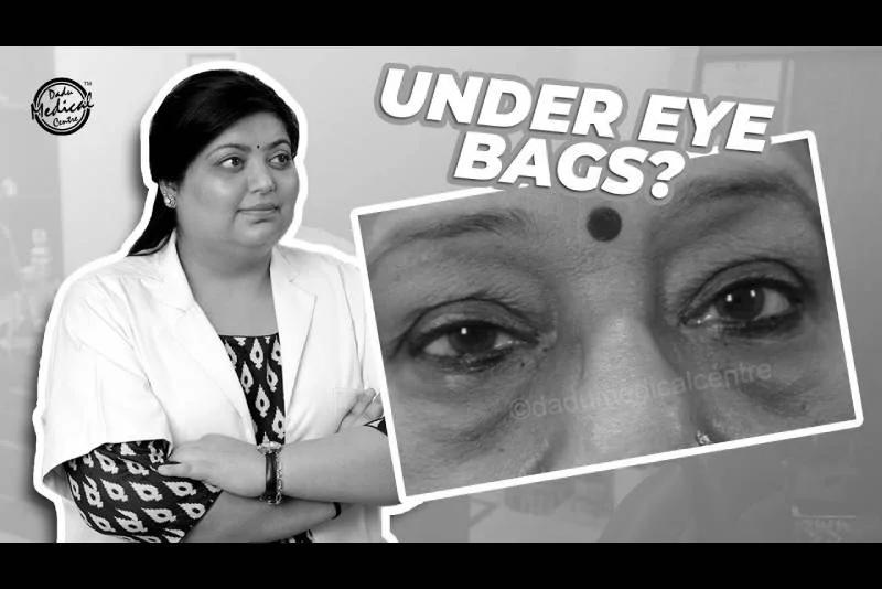 How to Get Rid of Under Eye Bags or Puffy Eyes? | Dr. Nivedita Dadu