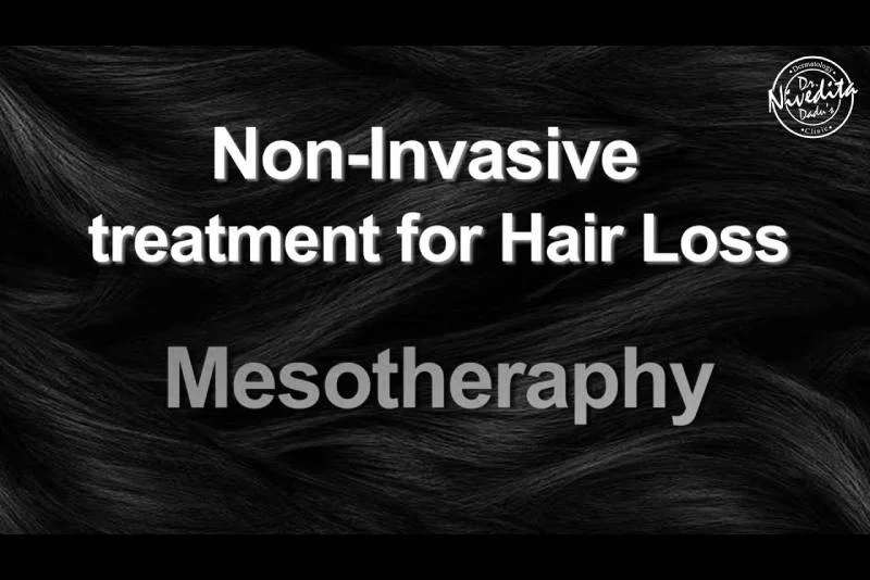 बाल झड़ने को रोकने का 100 % सही इलाज | Still struggling with hair fall? | Mesotherapy Treatment