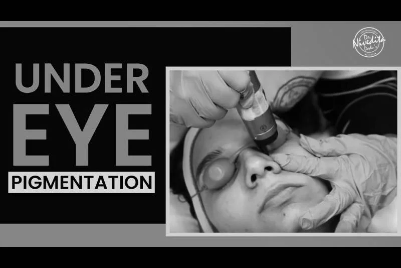 Laser treatment for dark circles under eyes | Under Eye Pigmentation Removal