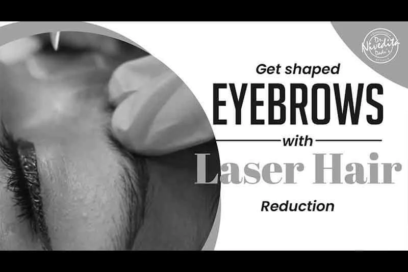 laser Hair Reduction से आईब्रो की शेप देना | Get Shaped Eyebrows with Laser Hair Reduction