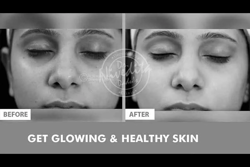 Instaglam Treatment for Glowing and Healthy Skin