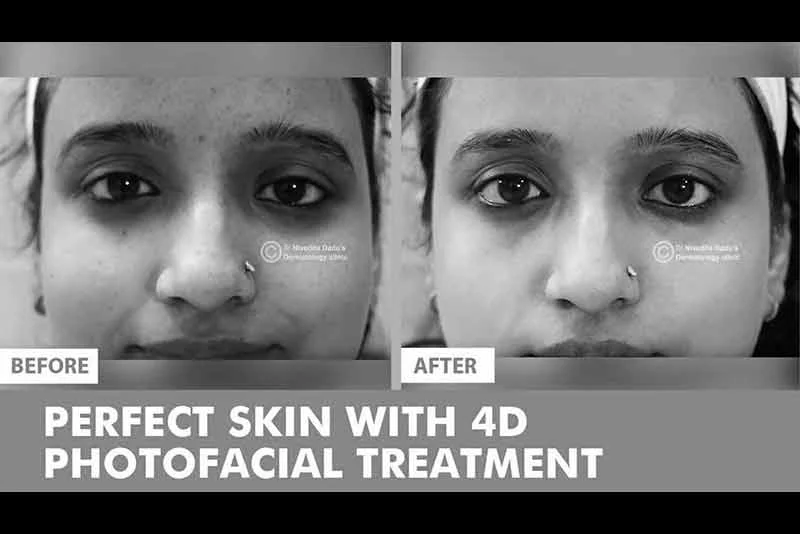 How does 4D Photofacial works? | Procedure by Dr. Nivedita Dadu, best Dermatologist in Delhi