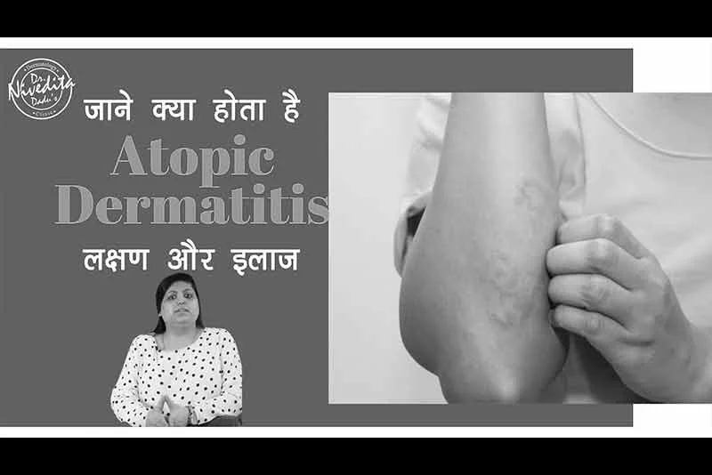 Atopic dermatitis (एक्जिमा) क्या है उसके लक्षण और इलाज