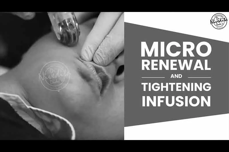 New Skin Treatment Launch | MARTINI | Complete Skin Rejuvenation with advanced Microneedling