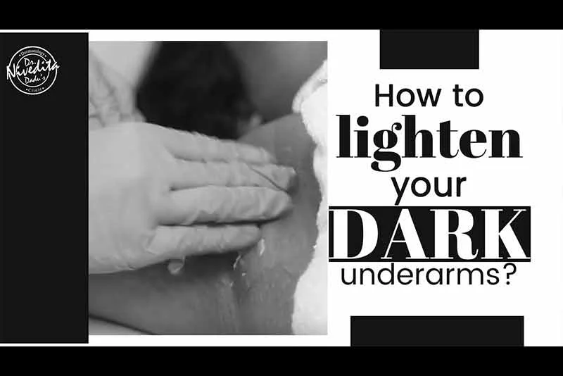 How to Get Rid of Dark Underarms | अंडरआर्म्स का कालापन दूर करे | Best Skin Specialist in Delhi