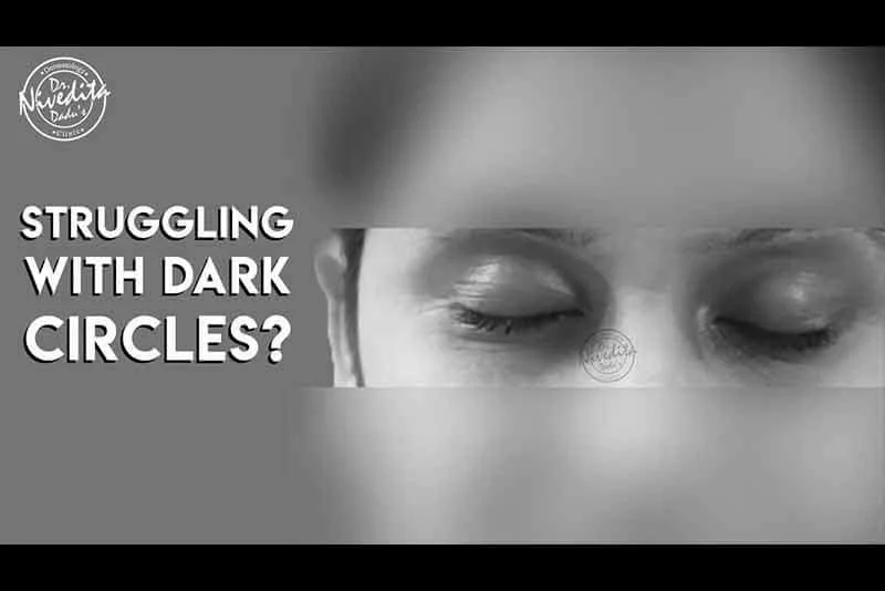 Laser treatment for dark circles under eyes