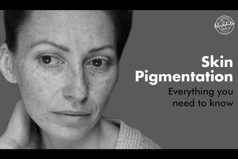 पिगमेंटेशन क्या होता है और इसे जड़ से खत्म करने का तरीका | Skin Pigmentation