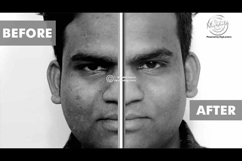 चेहरे के दाग धब्बे, पिंपल और चोट के निशान हटाने का laser इलाज | Dealing with photoaging & dark spots