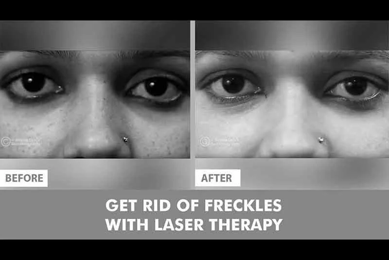 झाईयों का laser treatment | How to Get Rid of Freckles with Laser Treatment