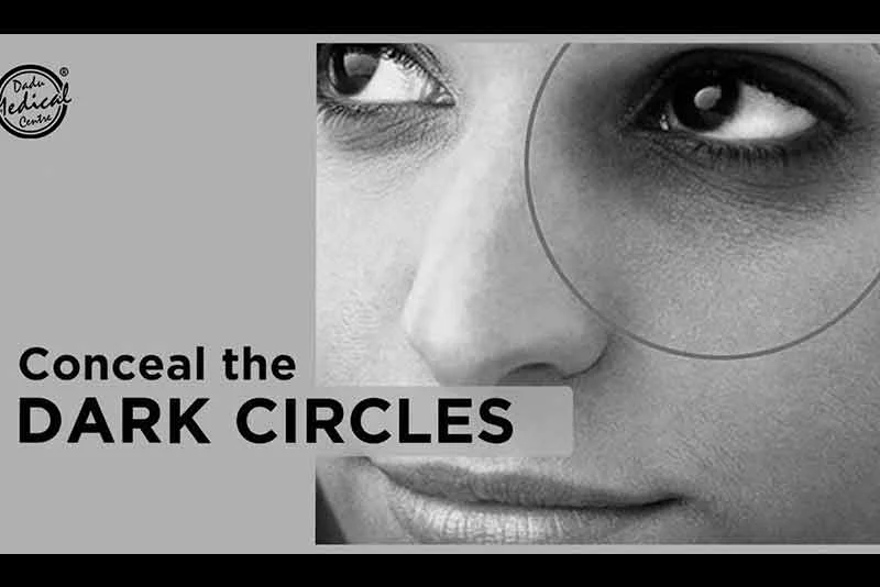 आंखों के काले धब्बे कैसे हटाए / How to Remove Dark Circle Under Eyes