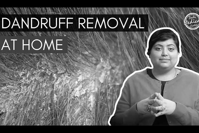 Dandruff Removal Treatment at Home | Get Rid Of Flaky Scalp And Dandruff | Home Remedies