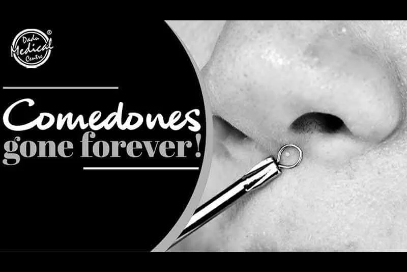 Comedones Removal | Blackheads को दूर भगाने का बेजोड़ उपाय | Dr. Nivedita Dadu's Dermatology Clinic