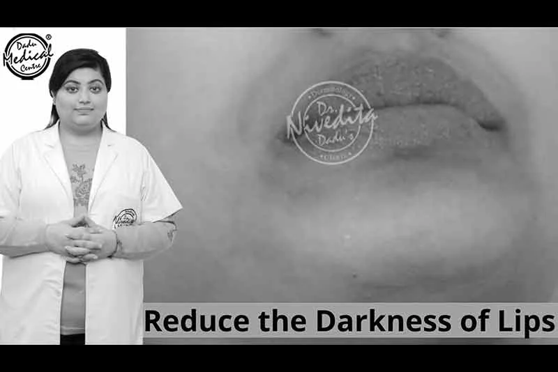 Black/Dark Lips Treatment by Dermatologist | Laser Lip Lightening for Dark Lips