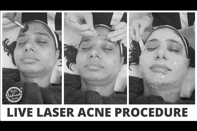 Say Goodbye to Acne - Live Laser Acne Procedure | Dr. Nivedita Dadu's Dermatology Clinic
