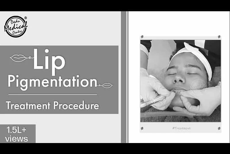 Dark Lips Treatment (Lip Pigmentation Treatment) | Lip Lightening Procedure | Black Lips Treatment