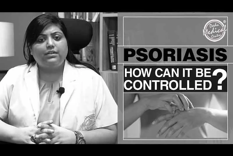 What is Psoriasis and how it can be controlled। Causes and Cure of Psoriasis