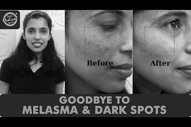 Bid Good Bye to Melasma & Dark Spot | Patient Testimonial | Dr. Nivedita Dadu's Dermatology Clinic