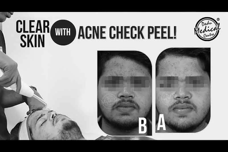 Acne Check Peel के साथ पाएं साफ़ त्वचा और कहें मुहाँसों को अलविदा