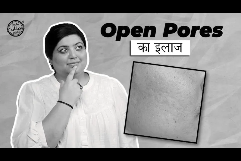 How To Treat Open Pores? | Best Treatment Options Available for Open Pores | Dr. Nivedita Dadu