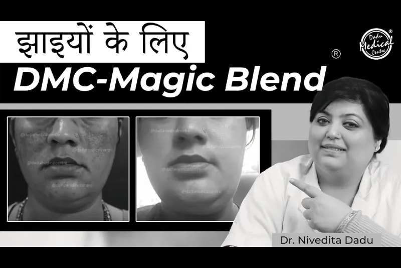 How to get rid of melasma? | DMC-Magic Blend Treatment®️ | Skincare Tips | Best skin clinic in Delhi