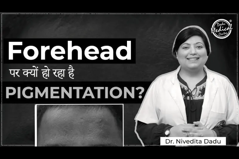 आपके skin pigmentation का कारण क्या बन रहा है? । Prevention & cure of pigmentation on forehead | DMC