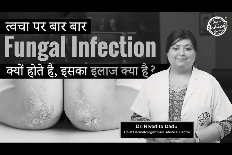 Skin Fungal Infection क्या होता है और इसका इलाज कैसे कर सकते है? | Causes, Prevention & Treatments