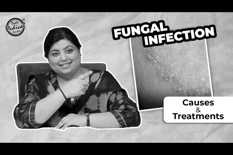 Fungal Infection on Skin | Causes & Treatment of Fungal Infection | फ़ंगस इनफ़ेक्शन का इलाज