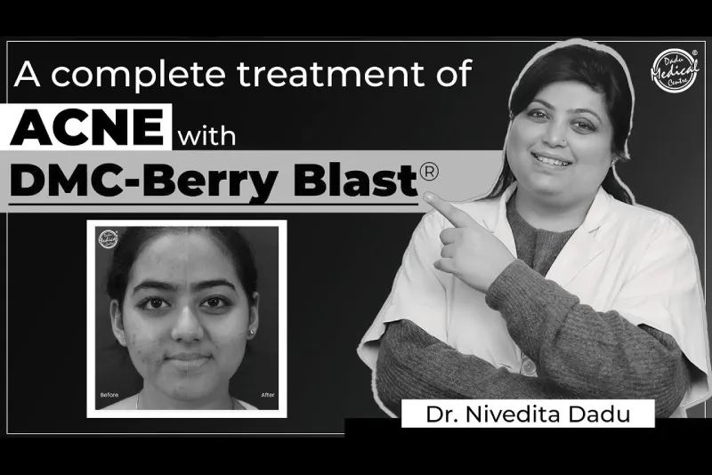 This treatment will completely eliminate Pimples & Acne Marks | DMC-Berry Blast®