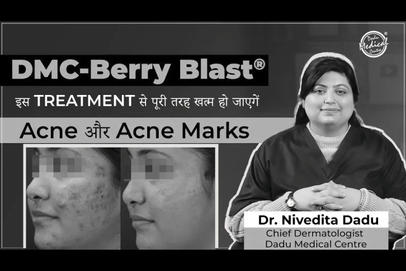 DMC-Berry Blast®: इस treatment से पुरी तरह खत्म हो जायेगा Acne, Acne-Marks और Acne Scars | Dr. Dadu